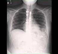 Image result for Left Lower Lobe Pneumonia