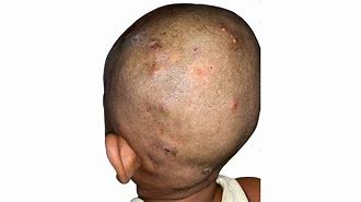 Image result for Bacterial Folliculitis Scalp