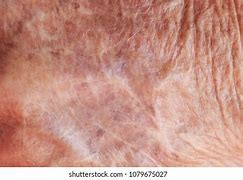 Image result for Skin Atrophy Diagram