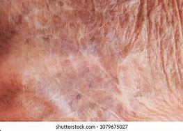 Image result for Sclerotic Atrophy of Skin