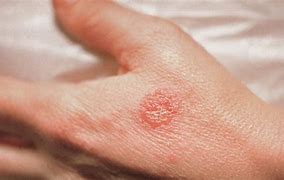 Image result for Raised Circular Lesion On Skin