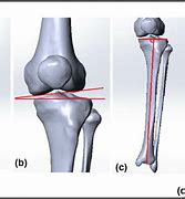 Image result for Deformity of Fibular Head