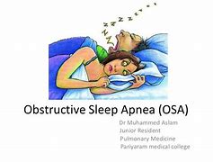 Image result for Osa Sleep Apnea