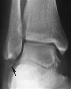 Image result for Avulsion Fracture