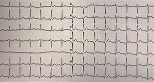 Image result for Pericarditis EKG Findings Example