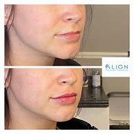 Image result for Versa Lip Filler