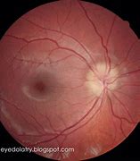 Image result for Enlarged Optic Nerve