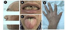 Image result for Acromegaly Teeth