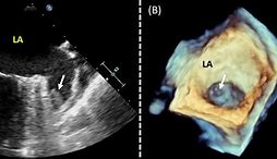 Image result for Right Atrial Appendage Thrombus