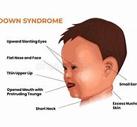 Image result for Down's Syndrome Diagram