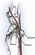 Image result for Volar Wrist Cyst