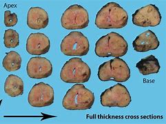 Image result for Gross Pathology Bladder Specimen