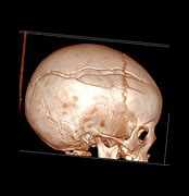 Image result for Skull Fracture