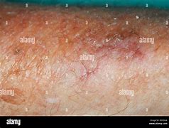 Image result for De Qinjection Atrophy Skin