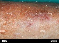 Image result for Sclerotic Atrophy of Skin