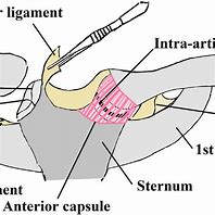 Image result for Left Sternoclavicular Joint