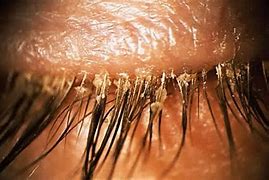 Image result for Demodex Mite Infestation