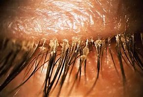 Image result for Demodex Infestation