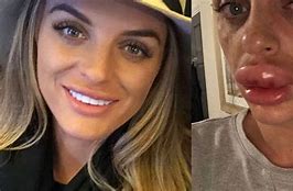 Image result for Worst Lip Fillers