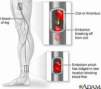 Image result for Arterial Emboli