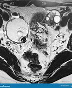 Image result for Teratoma