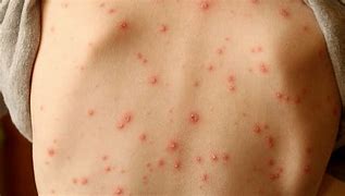 Image result for Rash Diagnosis