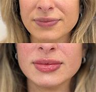 Image result for Hylauronic Pen Lip Filler