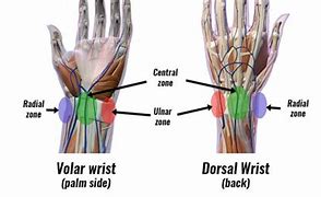 Image result for Pins in Wrist Pain