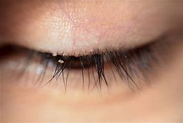 Image result for Eyebrow Mites On Humans