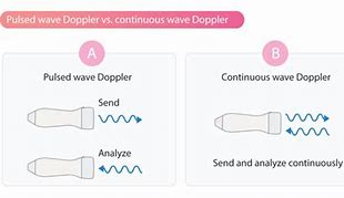 Image result for Continuous Wave Doppler Ultrasound