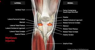 Image result for Right Knee Meniscus