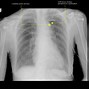 Image result for Aortic Rupture CXR