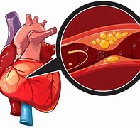 Image result for Coronary Artery Disease