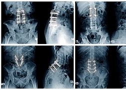 Image result for Lumbosacral Fusion