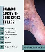 Image result for Dark Pigmentation On Legs