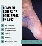 Image result for Dark Age Spots On Legs