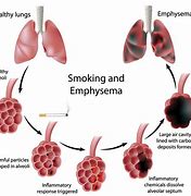 Image result for Chronic Emphysema