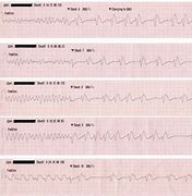 Image result for AFib vs V-fib