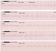 Image result for V-fib Heart Strip