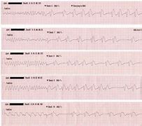 Image result for Ventricular Fibrillation Symptom