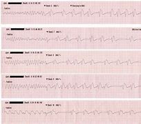 Image result for Ventricular Fibrillation EKG Examples