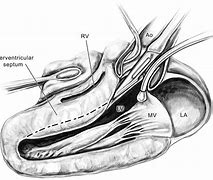 Image result for Right Ventricular Outflow Tract