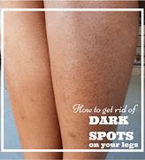 Image result for Dark Age Spots On Legs