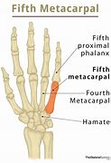 Image result for Fifth Digit Finger