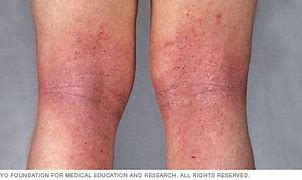 Image result for 10 Common Skin Rashes On Legs