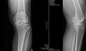 Image result for Left Knee Arthroplasty