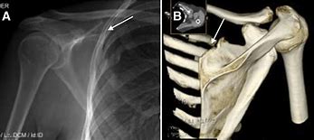 Image result for Scapulothoracic Bursectomy Arthroscopy