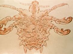 Image result for Crabs Infection