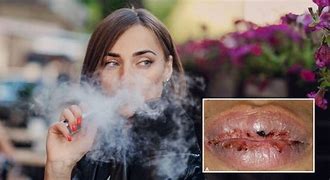 Image result for Vaping Mouth Ulcers