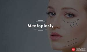 Image result for Mentoplasty